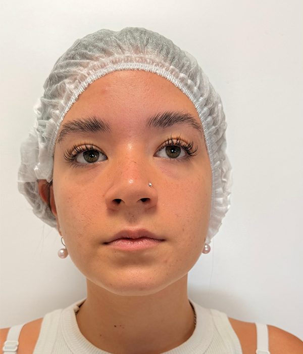 Antes: relleno de labios